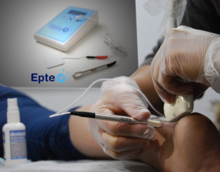 EPTE percutaneous electrolysis course in London